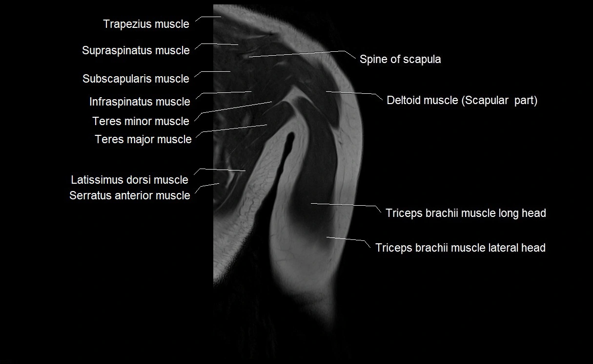 MRI upper arm (humerus ) coronal cross sectional anatomy image 26.webp